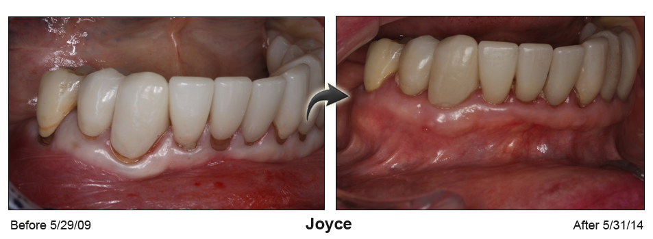 Joyce's gum recession resolved byChao Pinhole® Surgical Technique (PST)