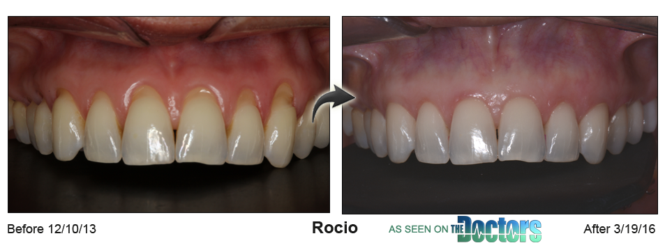 Rocio's gum recession resolved byChao Pinhole® Surgical Technique (PST)