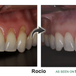 Rocio's gum recession resolved byChao Pinhole® Surgical Technique (PST)