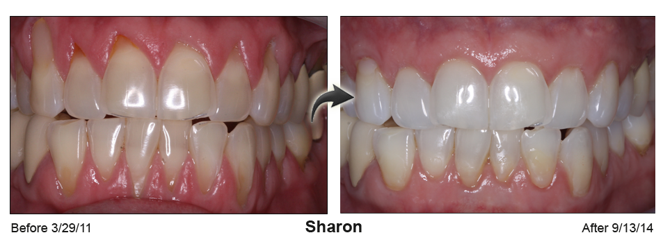 Sharon's gum recession resolved byChao Pinhole® Surgical Technique (PST)