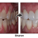 Sharon's gum recession resolved byChao Pinhole® Surgical Technique (PST)