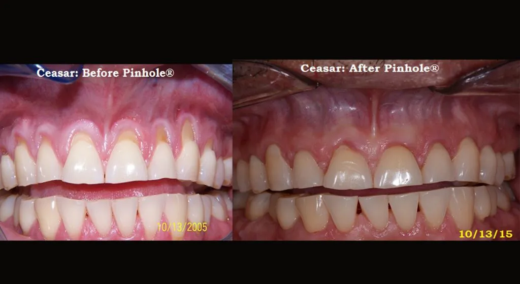 Ceasar's gum recession resolved byChao Pinhole® Surgical Technique (PST)