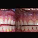 Ceasar's gum recession resolved byChao Pinhole® Surgical Technique (PST)