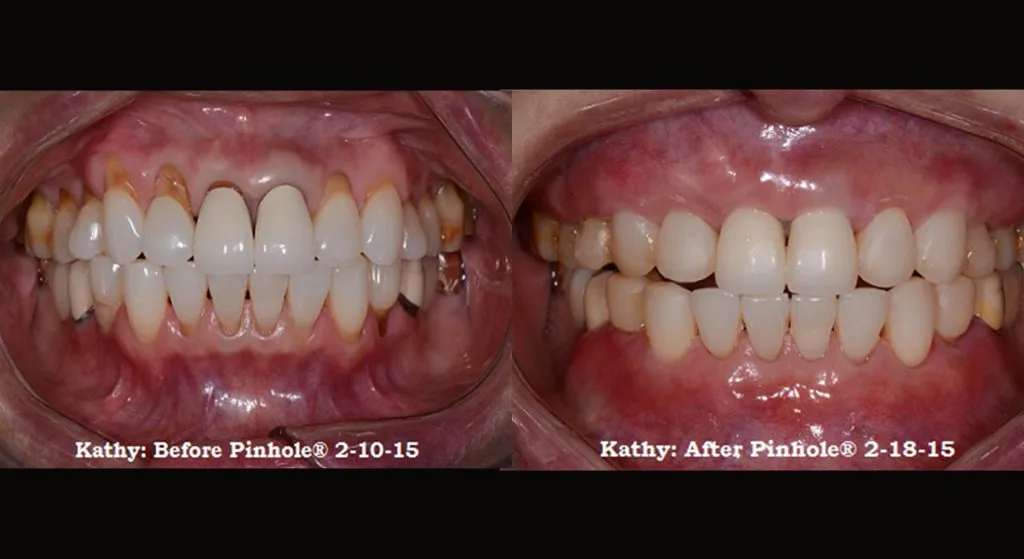 Kathy's gum recession resolved byChao Pinhole® Surgical Technique (PST)