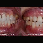 Kathy's gum recession resolved byChao Pinhole® Surgical Technique (PST)